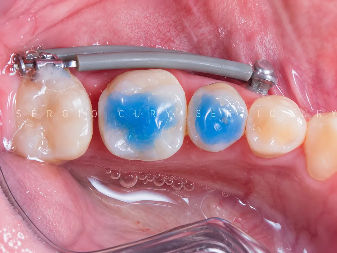 Etapa 4: El diastema